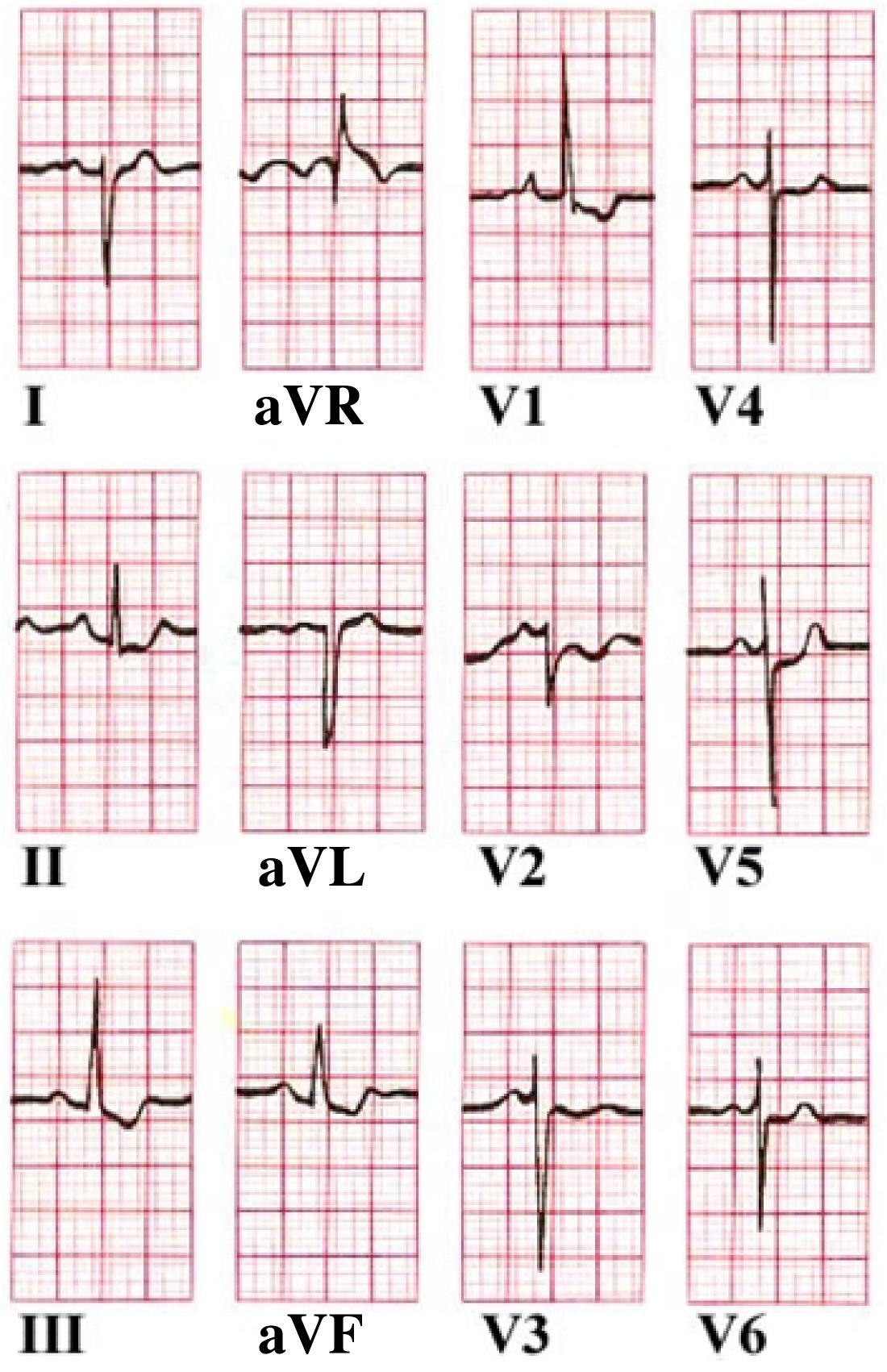 hoejre ventrikelhypertrofi-ekg
