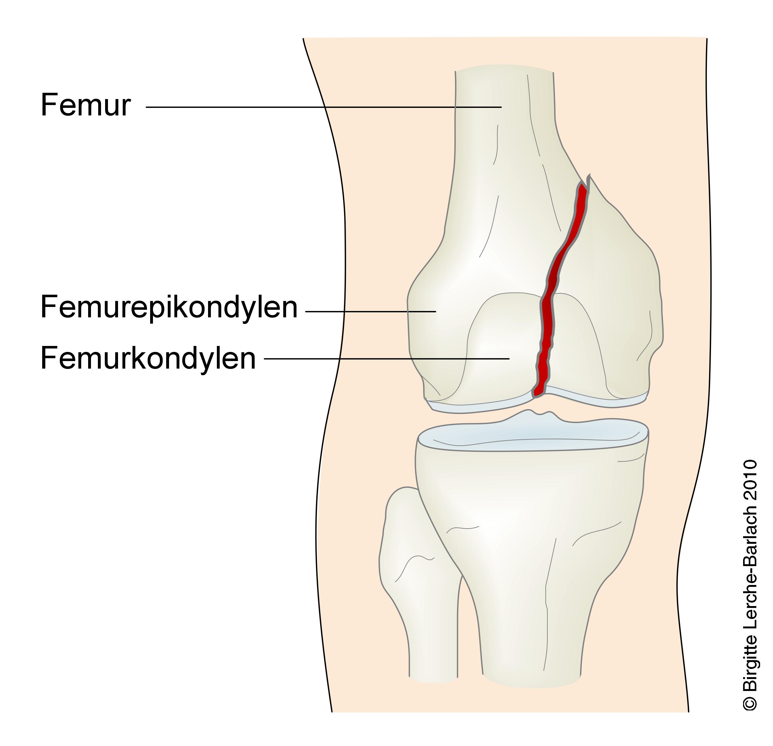 laar-fraktur transkondylaer femoris 7322