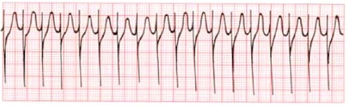 hjerte-nodal takykardi