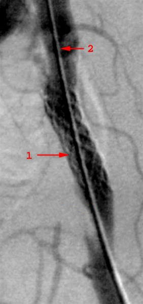 baekkenarterie-stent-rgt