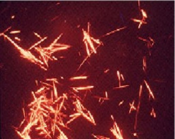 urinsur gigt-uratkrystaller