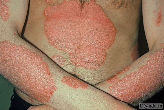 Psoriasis mave moderat