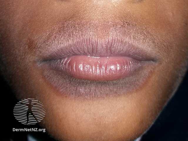 Atopisk eksem omkring munden 50384