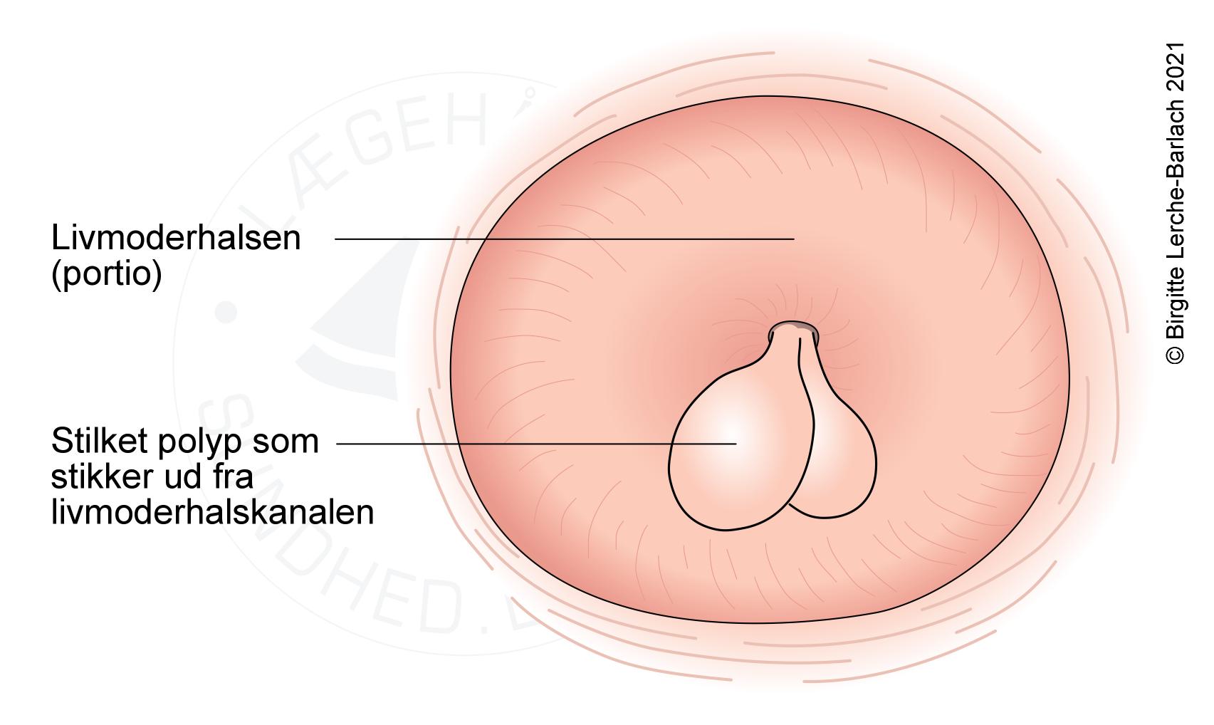 livmoderhals-cervixpolyp