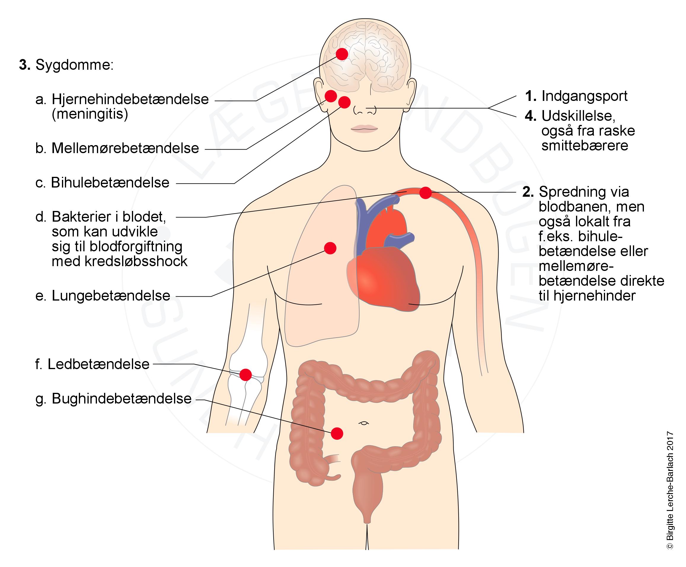 sygdomme foraarsaget af pneumokokker