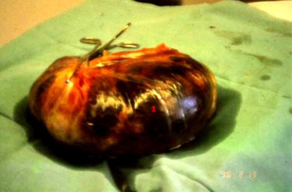 aeggestok-torkveret mucinoest cystadenom