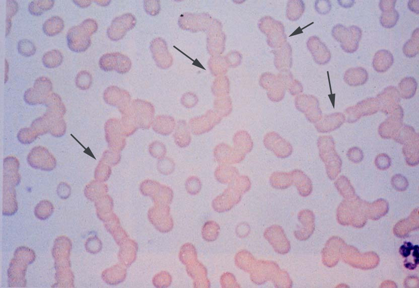 perifert blodudstryg med pengerulledannelse af erytrocytter jpg