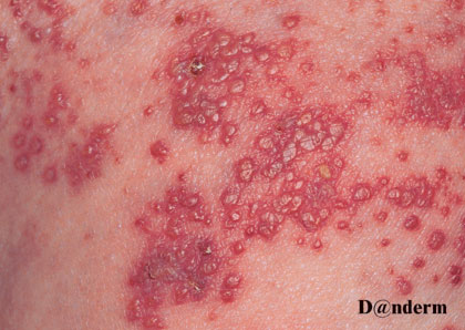 Herpes Zoster nærbillede