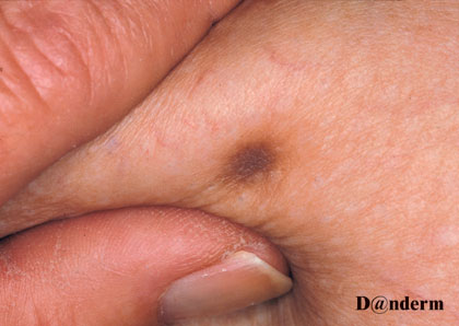 dermatofibrom_pigmenteret_dermnet