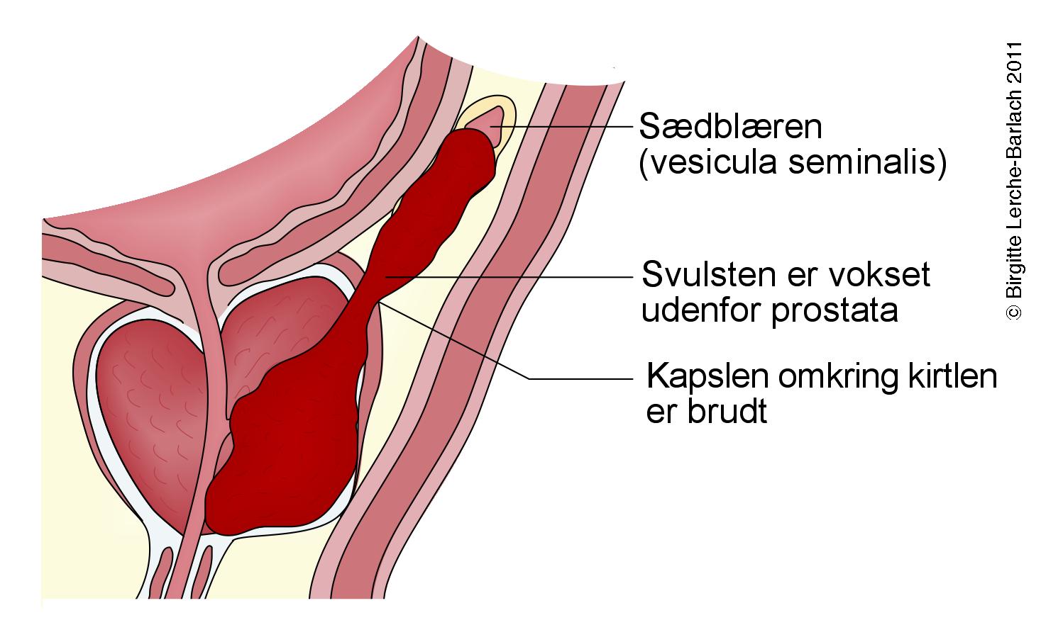 prostata-prostatacancer stadie 3