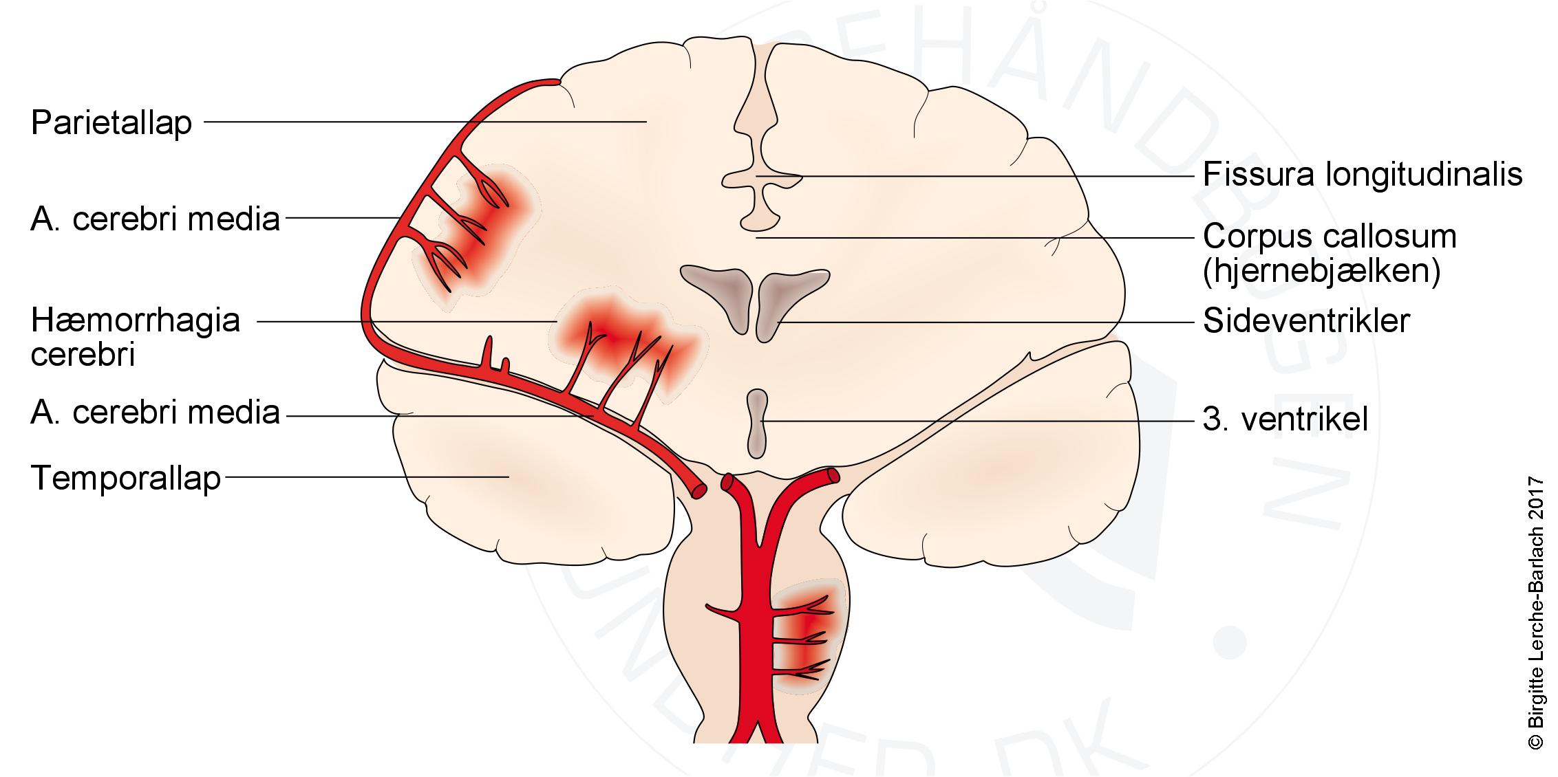 hjerne-ntracerebral bloedning