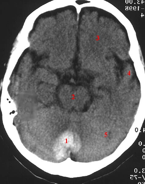 hjerne-haematom i cerebellum-ct
