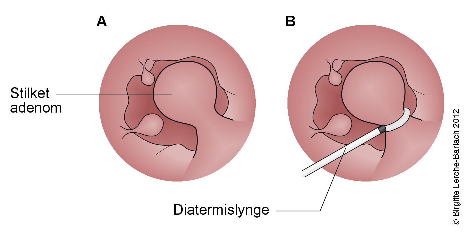 colon-adenom i colon
