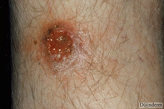basalcelle carcinom mimicking leg ulcer