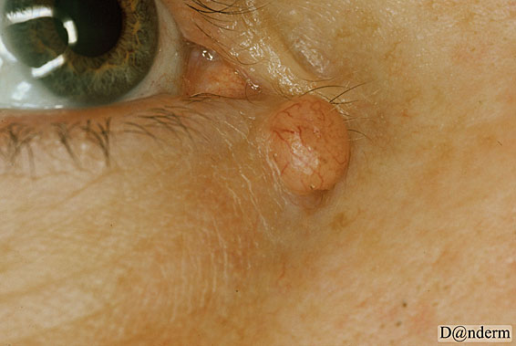 epidermoid_syste_lukket_dermnet