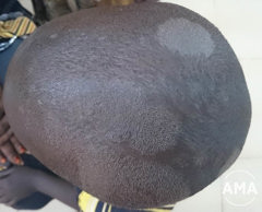 Foto af svampeinfektion i hårbunden