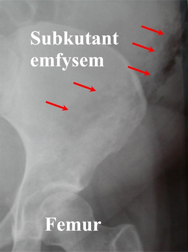 subkutant emfysem-roentgen