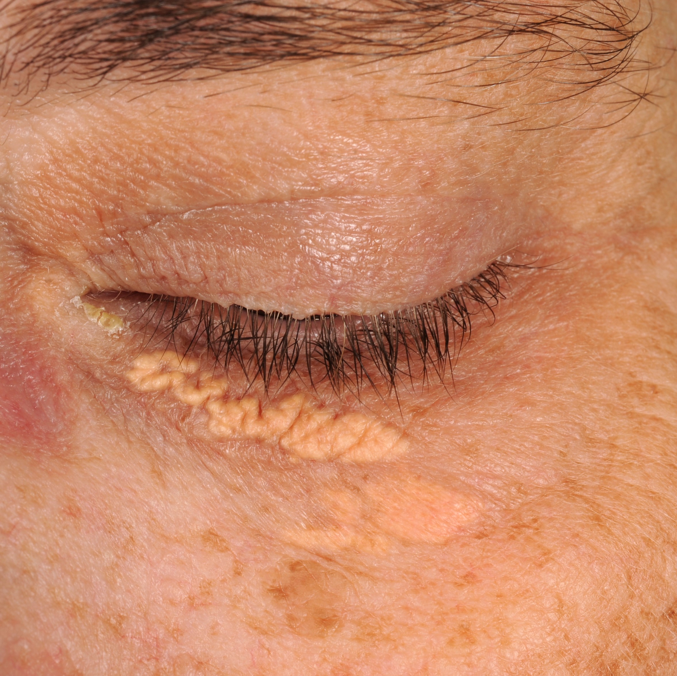 xanthelasmata under oejet