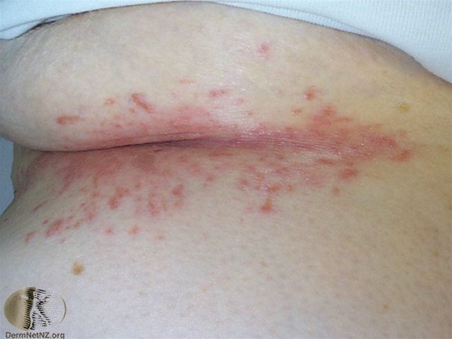 kutan candidiasis candida intertrigo ikke bruk