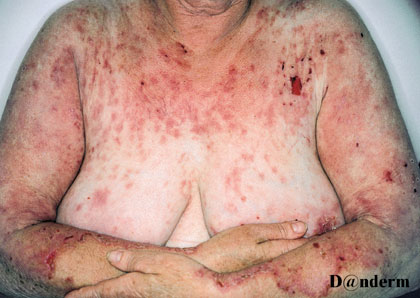 Pemfigus-overkrop
