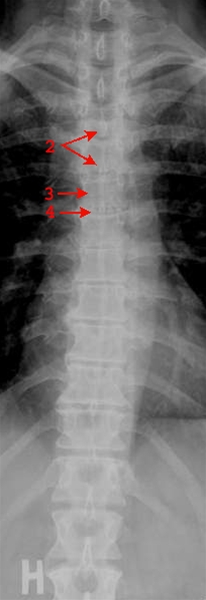 rygsoejle-normal-front-roentgen
