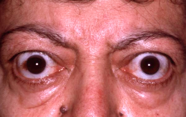 exoftalmus frontal jpg