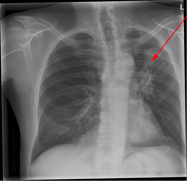 lunger-lungetumor-roentgen