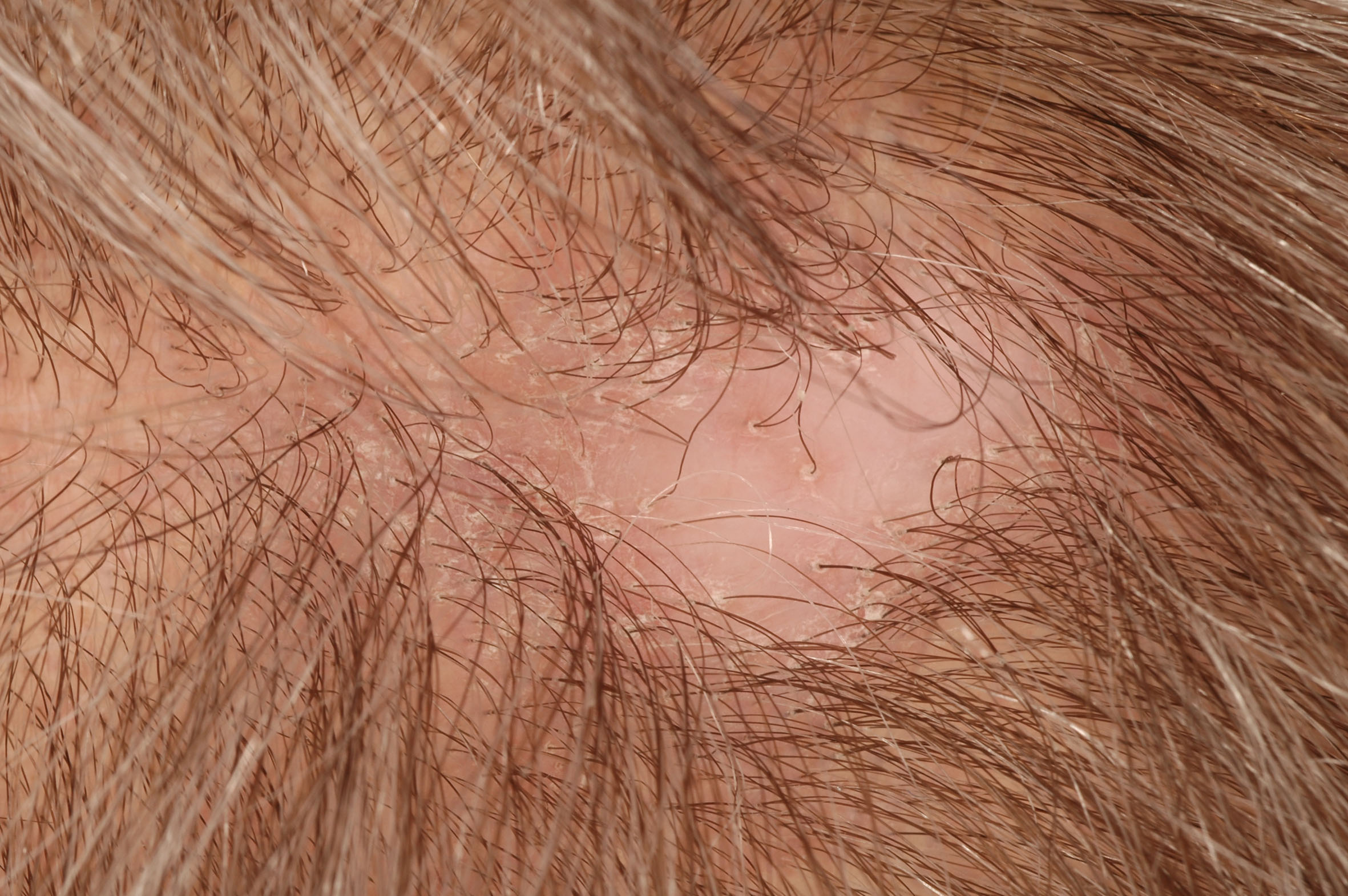 alopeci lokaliseret