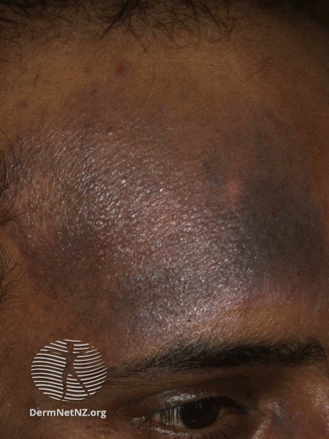 Mrkfarvning hyperpigmentering af huden atopisk eksem 50383