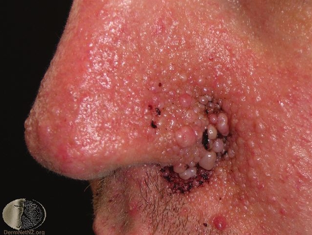 tuberoes sklerose angiofibrom sen