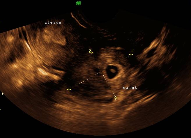 livmoder-tidlig intrauterin graviditet-ultralyd