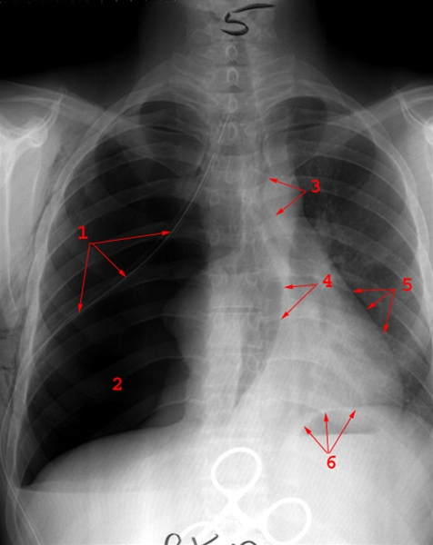 lunge-ventilpneumothorax-roentgen