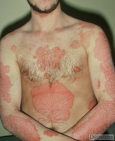 Psoariasis overkrop