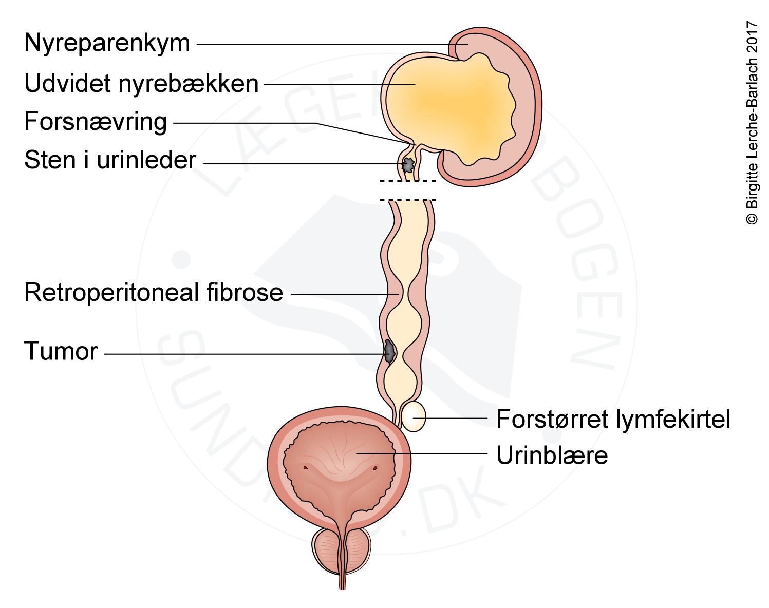 nyre-hydronefrose aarsager