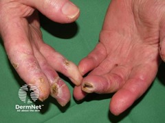 Foto af fingerspidser med nekrose
