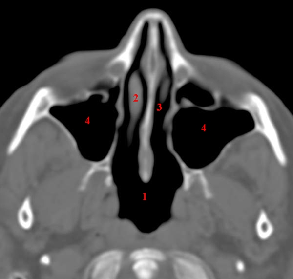 naese-maxillarsinus axial-ct