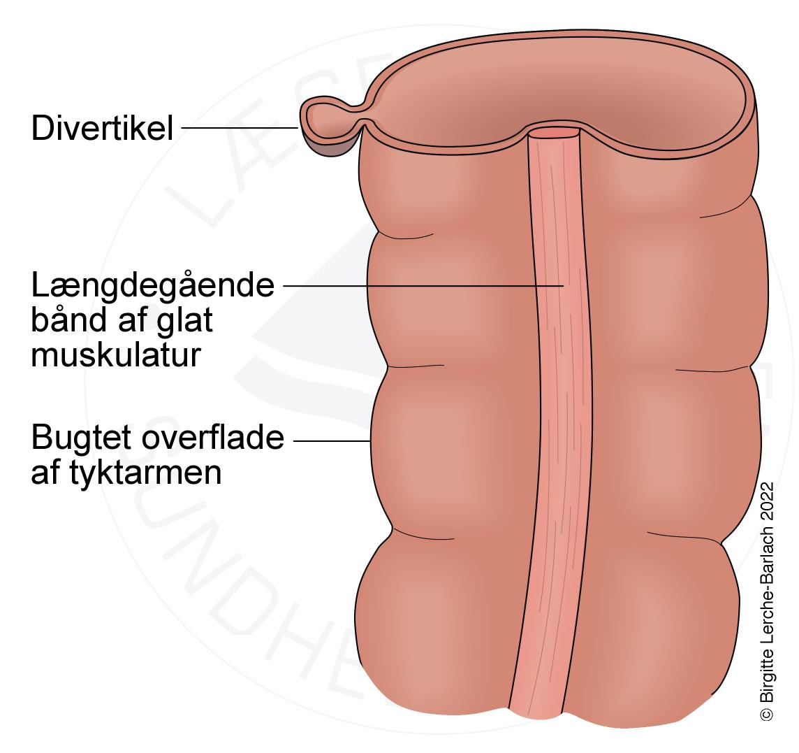colon-divertikler