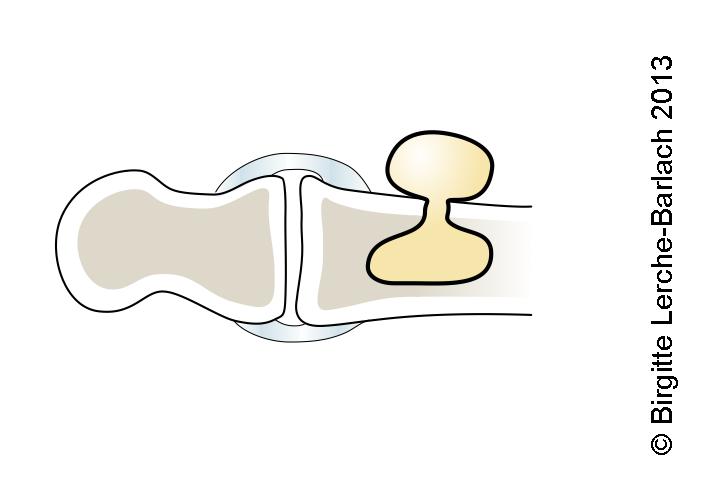 seneknude-intraossoest