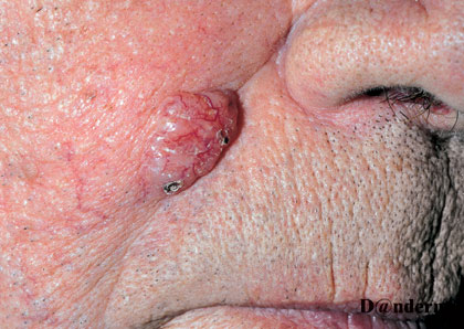 Basalcelle carcinom nodulaer