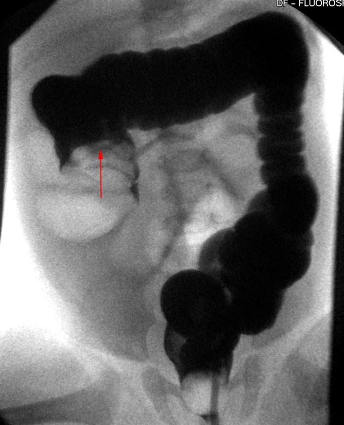 colon-invagination-roentgen