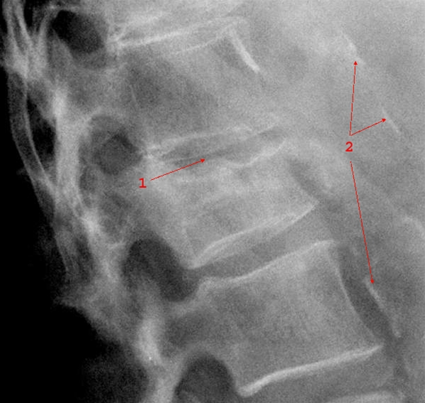 columna-fraktur sidebillede-roentgen