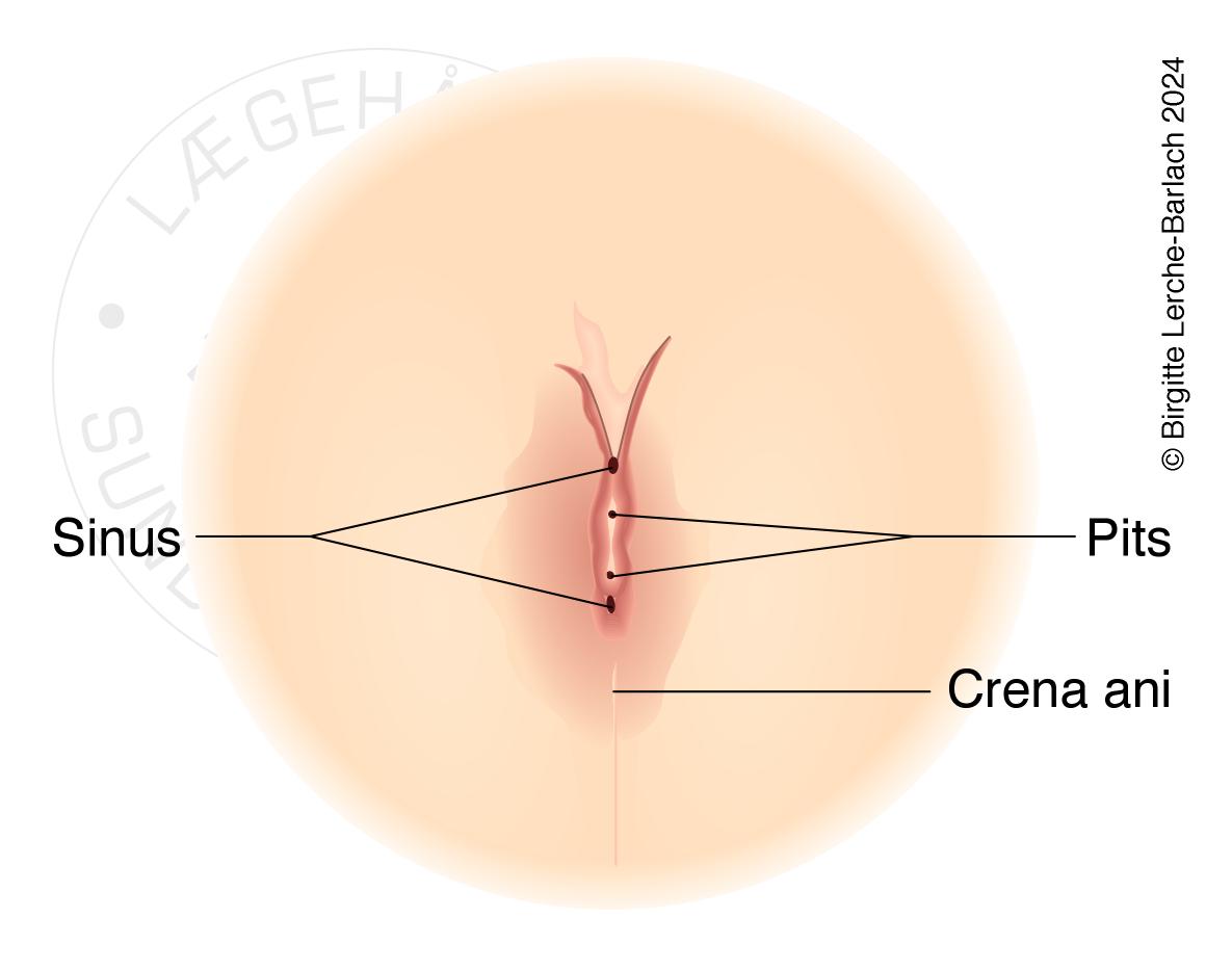 LH_Pustuloese tilstande