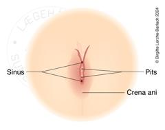 Tegning der viser pilonidal sinus