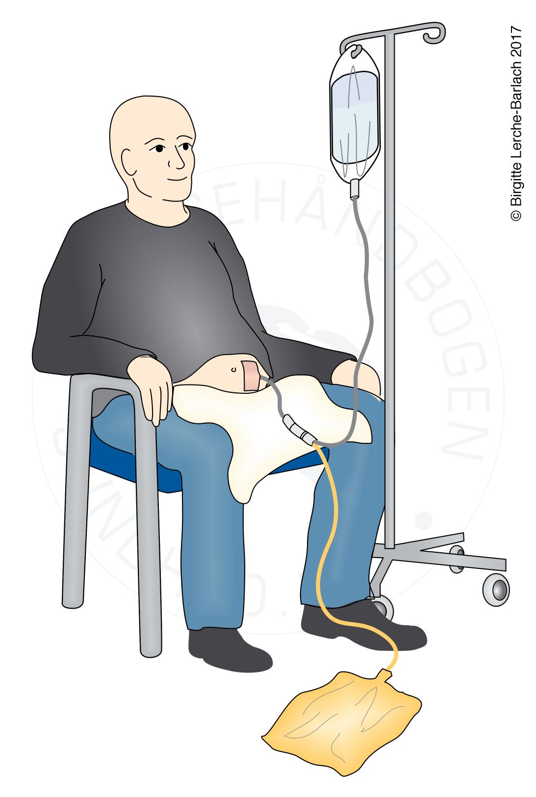 nyrer-peritonaldialyse