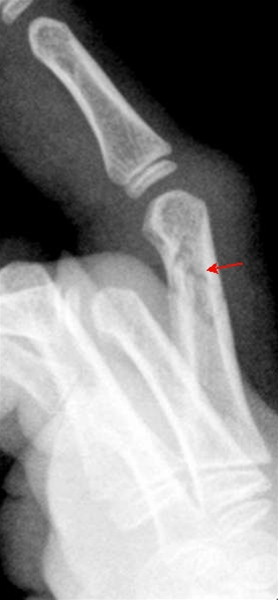 finger-phalanx fraktur-side-roentgen