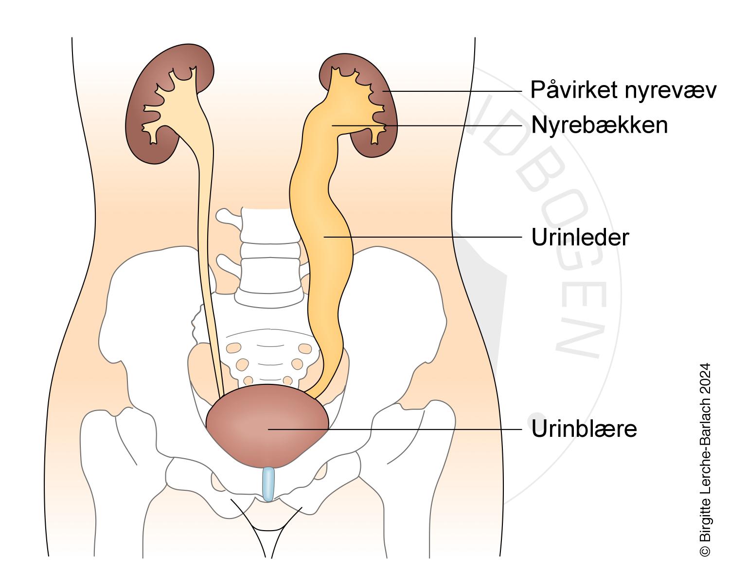 LH_512 Grad 4 refluks urin