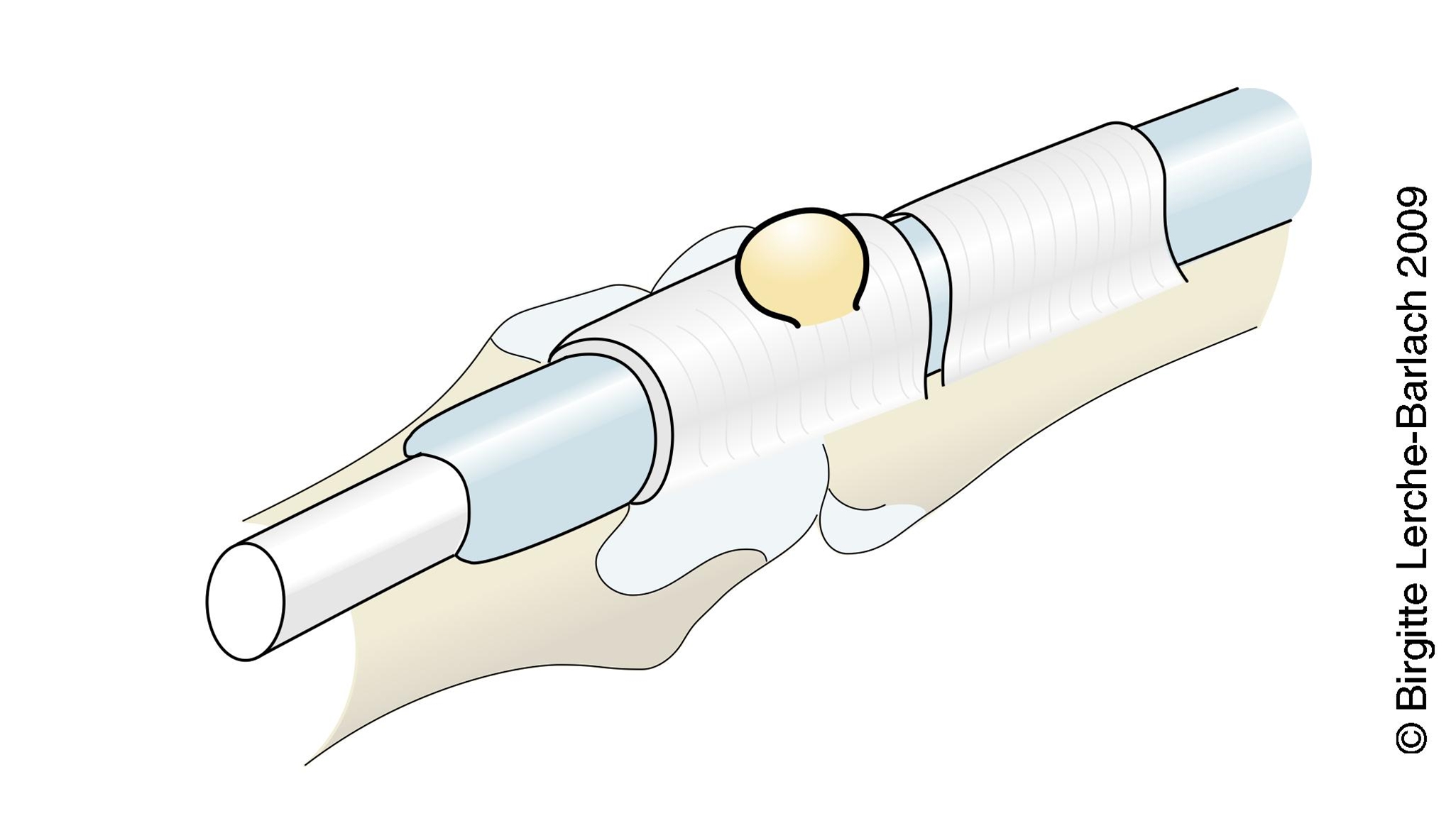 ganglion udgaaende fra seneskeden jpg