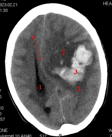 hjerne-cerebral bloedning med overskyvning-ct