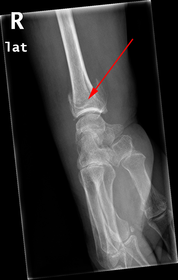 haand-distal radius fraktur-roentgen