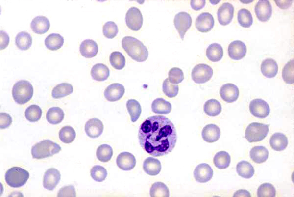 blodceller-makrocytaer anaemi x 100